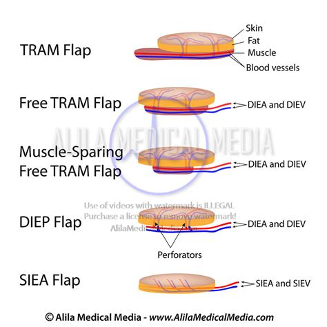 diep flap surgery photos.